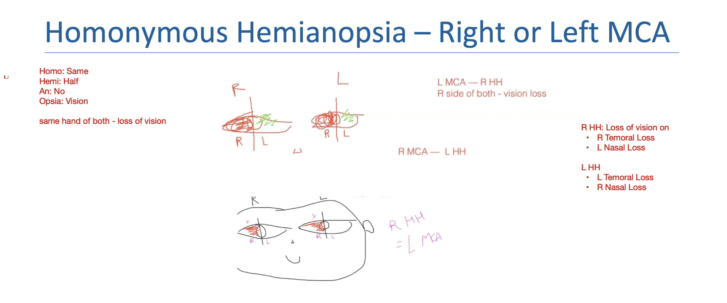 <p>What:</p><ul><li><p>Vision loss on same side of both eyes </p></li><li><p>R HH = L MCA</p><ul><li><p>R Temporal Loss</p></li><li><p>L Nasal Loss</p></li></ul></li><li><p>L HH = R MCA</p><ul><li><p>L Temporal Loss</p></li><li><p>R Nasal Loss</p></li></ul></li></ul><p></p>