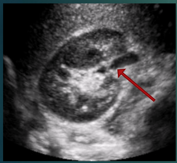 <ul><li><p>Large cavity formed by calyces</p></li><li><p>Flat and funnel-shaped</p></li><li><p>Continuous with the ureter leaving the pelvis</p></li><li><p>Medial to hilum</p></li></ul><p></p>
