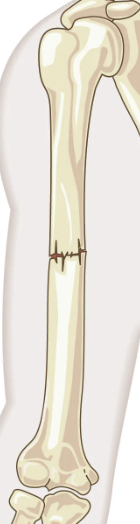<p><strong><mark>a broken bone where the skin is not pierced</mark></strong><span style="font-family: Google Sans, Roboto, Arial, sans-serif">.</span></p>