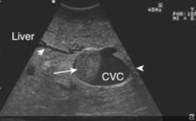 <p>1. endoscopy (visualization of blood in trachea)</p><p>2. ultrasound: liver abscess, dilation of CVC</p><p>3. radiographs (only works in about 1/3 of cows due to size)</p>