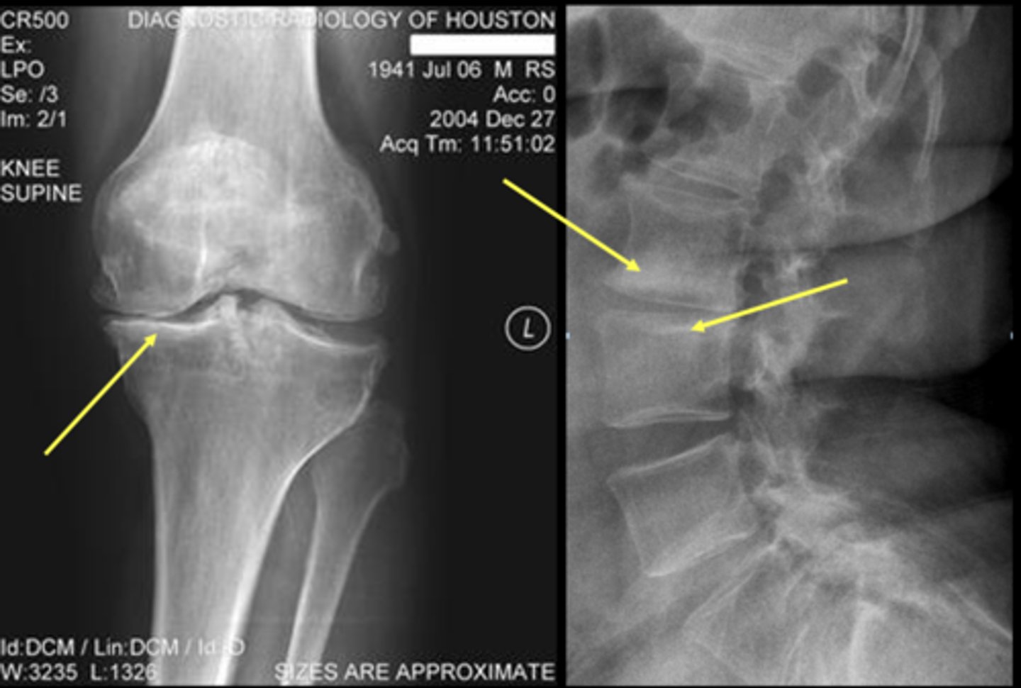 <p>Increased density of bone just deep to articular surface</p>