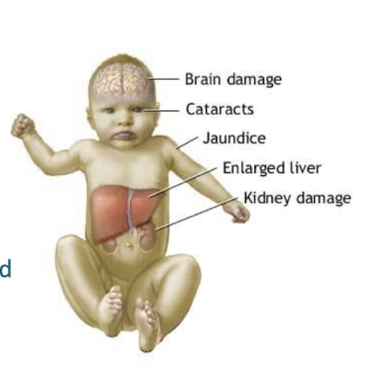 <p>galactose 1-phosphate, liver</p>