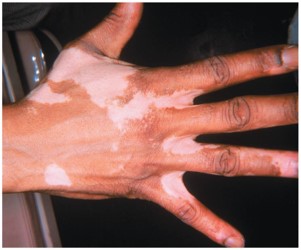 <ul><li><p>loss of color in patches of melanocyte populations</p></li></ul><p></p>