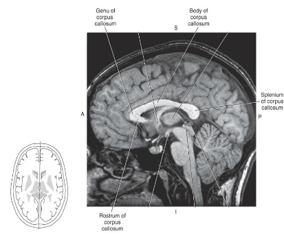 <p>What is the Corpus Callosum and what is its function?</p>