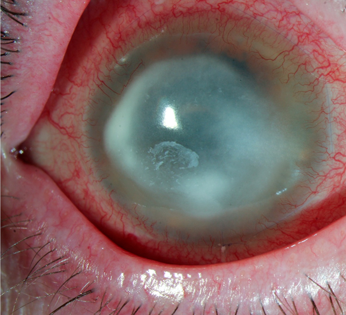 <p>What is the patient likely suffering from? </p><ul><li><p>The patient is a contact lens wearer, and recently went swimming in them as they don’t like to swim in their glasses</p></li><li><p>The patient recently scratched their eye</p></li><li><p>The patient is in a significant amount of pain</p></li><li><p>There are not many outward signs to match their symptoms</p></li><li><p>On slit lamp examination, there is a faint ring-shaped ulcer and some pus pooling in the cornea (<strong>hypopyon)</strong></p></li></ul><p></p>