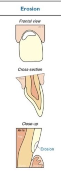 <p>teeth in groups- lingual on upper and buccal on lowers </p>