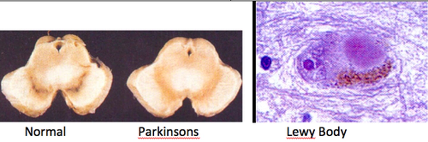 <p>Parkinson disease (loss of dopaminergic neurons in substantia nigra pars compacta)</p>