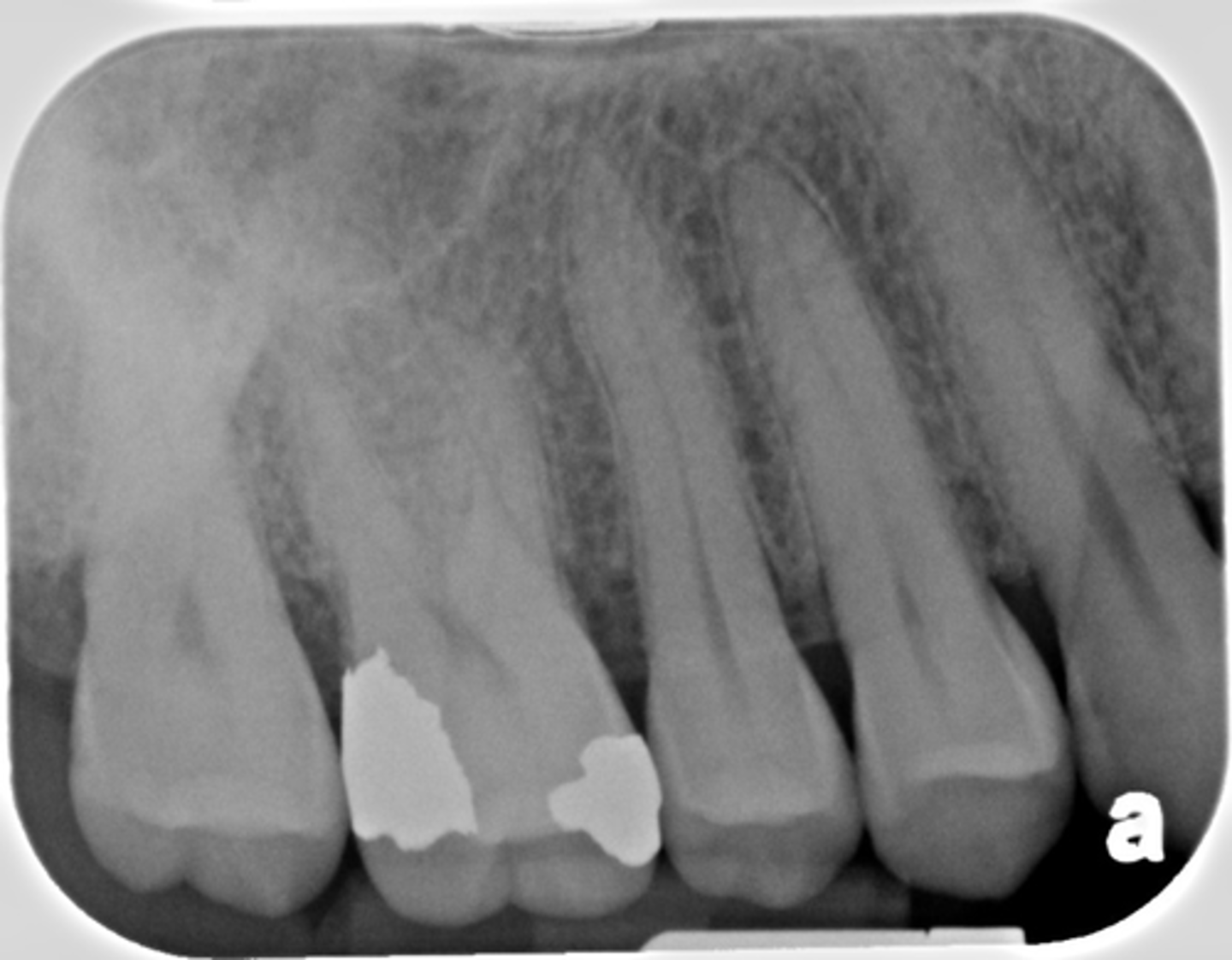 <p>They showed elongated anterior teeth and they ask about the cause of the error</p>