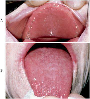 <p>-Intensely erythematous and atrophic mucosaunder a maxillary denture</p><p>•The mucosa is highly sensitiveand periodically painful</p><p>•Smooth, beefy-red, sensitive tonguedue to loss of papillae(resulting from long-term persistent candidiasis)</p><p>•Mild form of Candida albicans-induced angular cheilitis(also known as perlèche)</p>