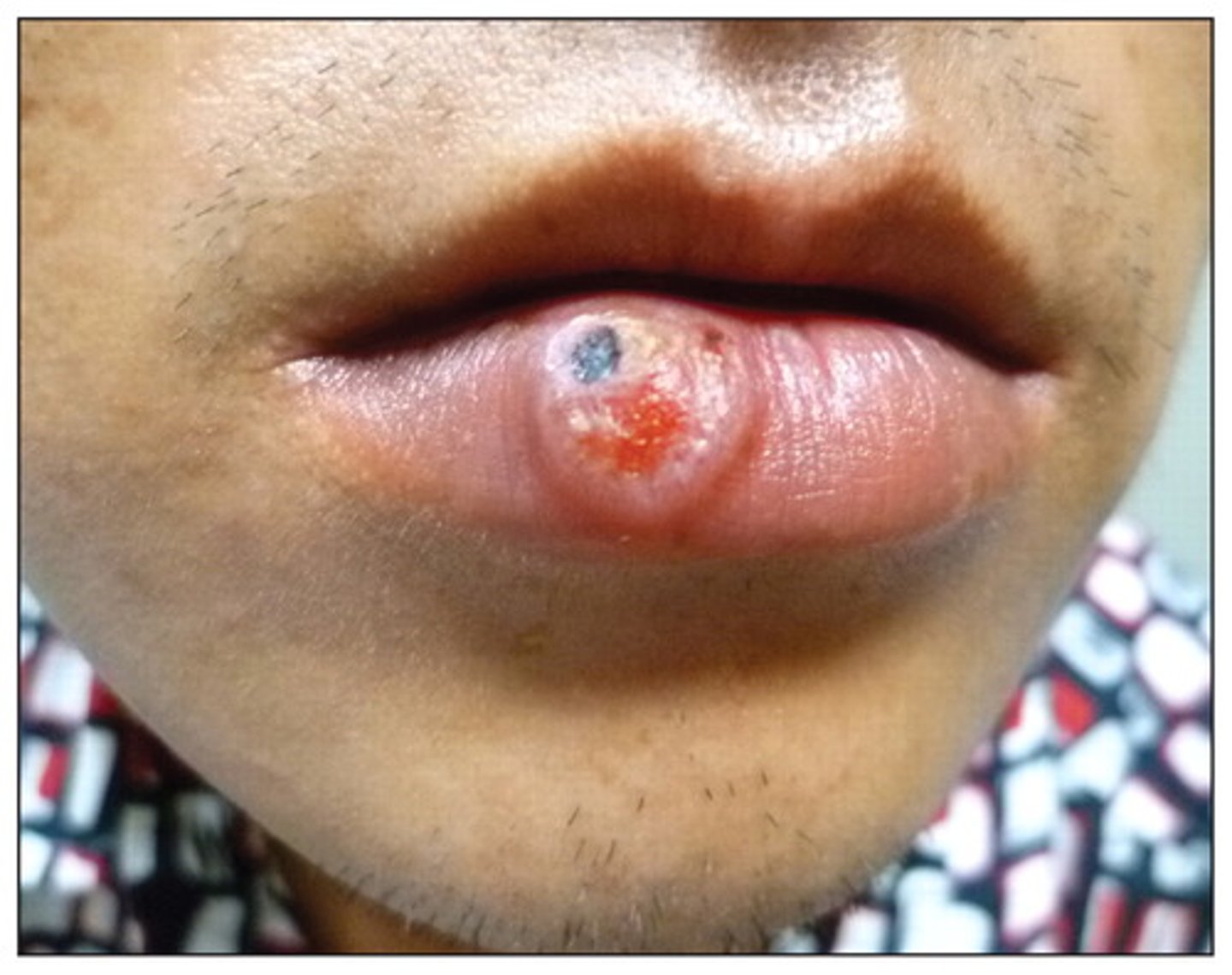 <p>Primary Syphilis (T. Pallidum)</p>