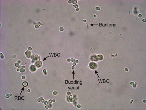 <ul><li><p>appears as small, refractile oval structures that may or may not contain a bud</p></li><li><p>may also appear branched, mycelial forms in severe infections</p></li></ul><p></p>