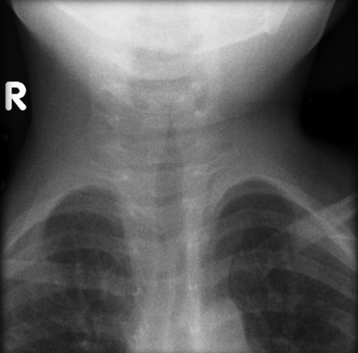 <p>What abnormality is shown here in this soft tissue neck x-ray? What would you diagnose this patient with?</p>