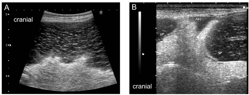 <p>USG (detects splenomegaly and a lacy pattern).</p>