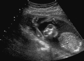 <p><span><span>A patient presents for an ultrasound to determine gestational age. An image of this early second- trimester fetus is most suspicious for:<br></span></span></p>