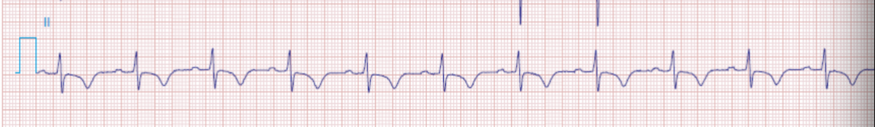 <p>ECG with no ST elevation, ST depression sometimes</p>