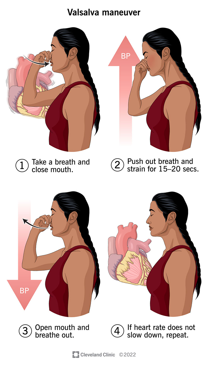 <p><span style="font-size: inherit; font-family: inherit"><strong>Ask the patient to take a deep breath in, then pinch their nose and try to pop their ears like on a plane [to accentuate the murmur of HOCM, mitral valve prolapse]</strong></span></p><ul><li><p>Listen over the left sternal edge (Erb's Point) with the <strong>diaphragm</strong> [<em>for mid-systolic murmur of HOCM which gets louder on Valsalva</em>]</p></li><li><p>Listen over the mitral area with the <strong>diaphragm</strong> [<em>for late-systolic murmur of mitral valve prolapse which gets louder on Valsalva</em>]</p></li></ul><p></p>