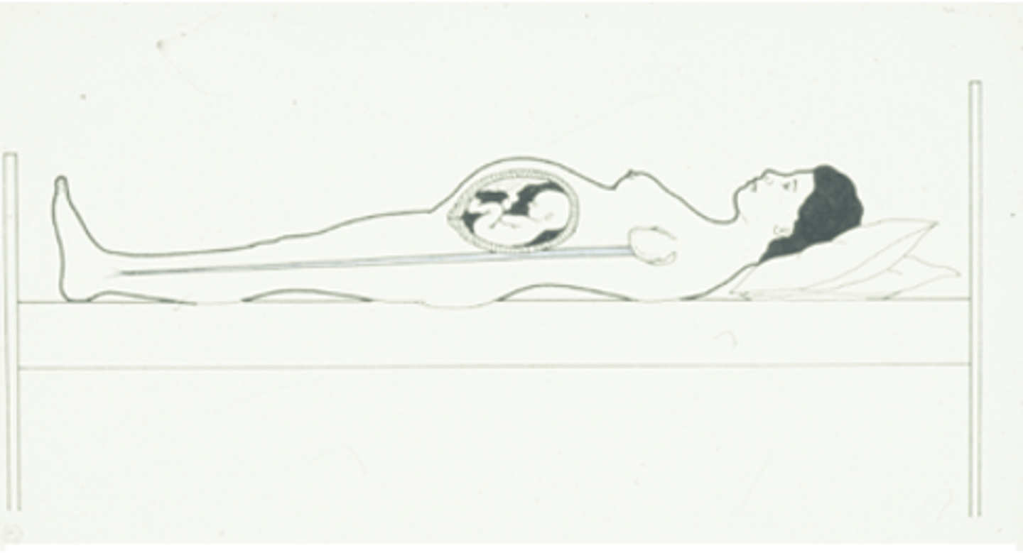 <p>Markedly lower when supine than in lateral position. No woman should lie supine in late pregnancy. </p>