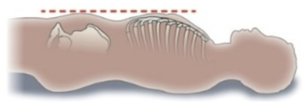 <p>Abdominal contour that appears sunken or concave, often indicating issues like malnutrition or dehydration</p>