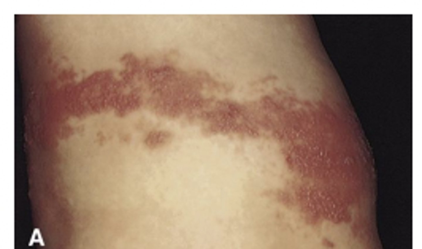 <p>chicken pox and shingles</p>