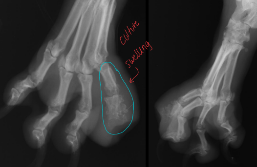 <p>Osteomyelitis</p>