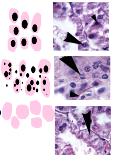 <p>Match name to picture:</p><ul><li><p>Pyknosis</p></li><li><p>Karyolysis</p></li><li><p>Karryorrhexis</p></li></ul><p></p>