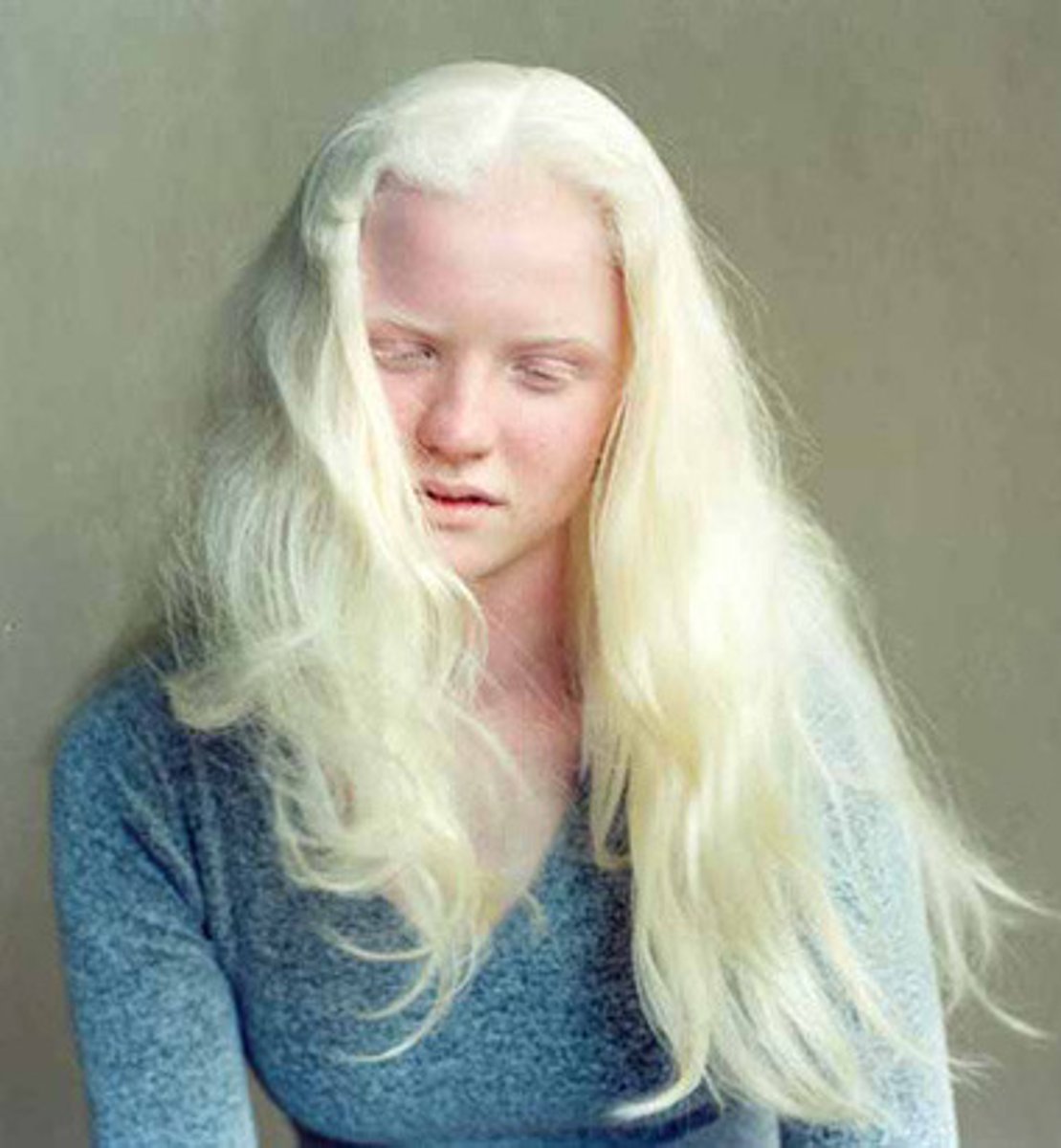 <p>lack pigment or melanin at all. no cure and bad sunburns</p>