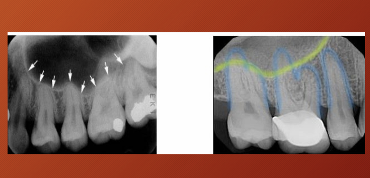 <p>What has happened to the maxillary sinus in this image?</p>