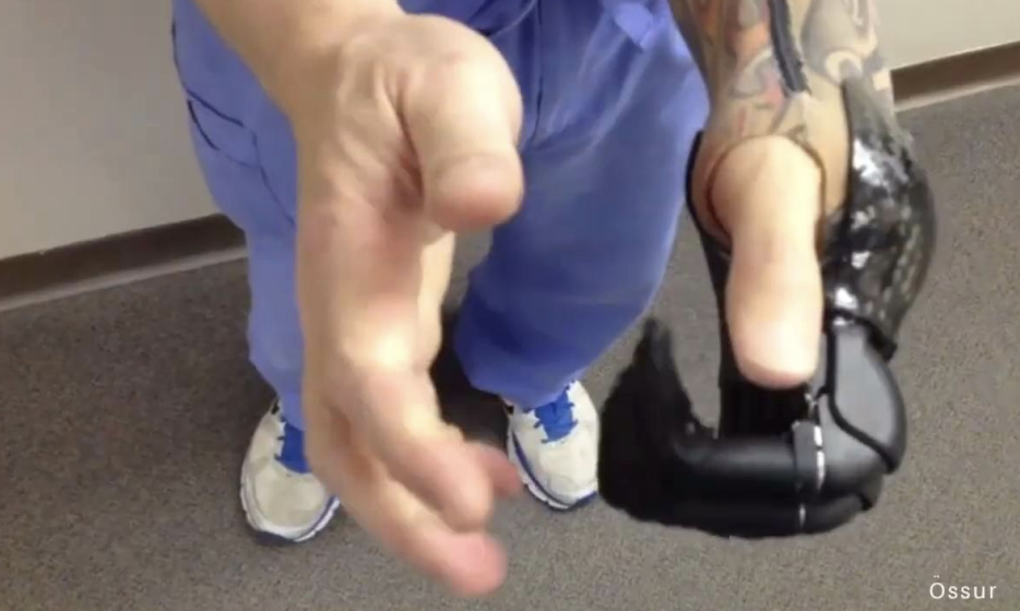 <p>Externally powered prostheses</p>