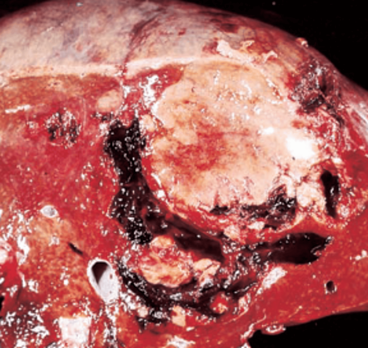 <p>A 25-year-old woman complains of sudden onset of acute abdominal pain. Physical examination shows abdominal distention. Her temperature is 37°C (98.6°F), respirations 22 per minute, heart rate 110 per minute, and blood pressure 70/50 mm Hg. A tap of the abdomen returns blood. A CT scan reveals a solitary 20-cm mass of the liver. A surgically resected portion of the liver is shown in the image. This patient's tumor was most likely associated with chronic exposure to which of the following?</p><p>(A) Carbon tetrachloride</p><p>(B) Halothane</p><p>(C) L-thyroxine</p><p>(D) Oral contraceptives</p><p>(E) Vinyl chloride</p>