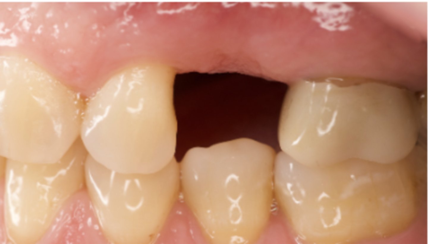 <p>What is the minimum inter-occlusal space required for a screw-retained implant supported single crown? (Select one answer)</p><p>7mm</p><p>4mm</p><p>6mm</p><p>5mm</p>