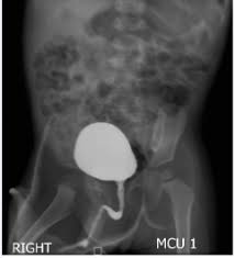 <ul><li><p><span>Vesicoureteric reflux (VUR)</span></p></li><li><p><span>Recurrent UTIs</span></p></li><li><p><span>Congenital abnormalities</span></p></li><li><p><span>Posterior urethral valves</span></p></li><li><p><span>Unstable bladder</span></p></li></ul><p></p>