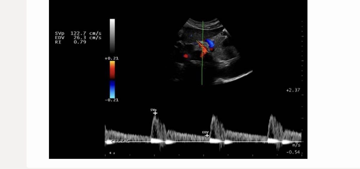 <p>image is from the celiac axis. which is the likely finding when the vessel is re-evaluated after eating</p><p>.</p><p>a) decreased resistance + increased peak velocity</p><p>b) decreased resistance w/no change in peak velocity</p><p>c) increased resistance + peak velocity</p><p>d) no change in flow </p>