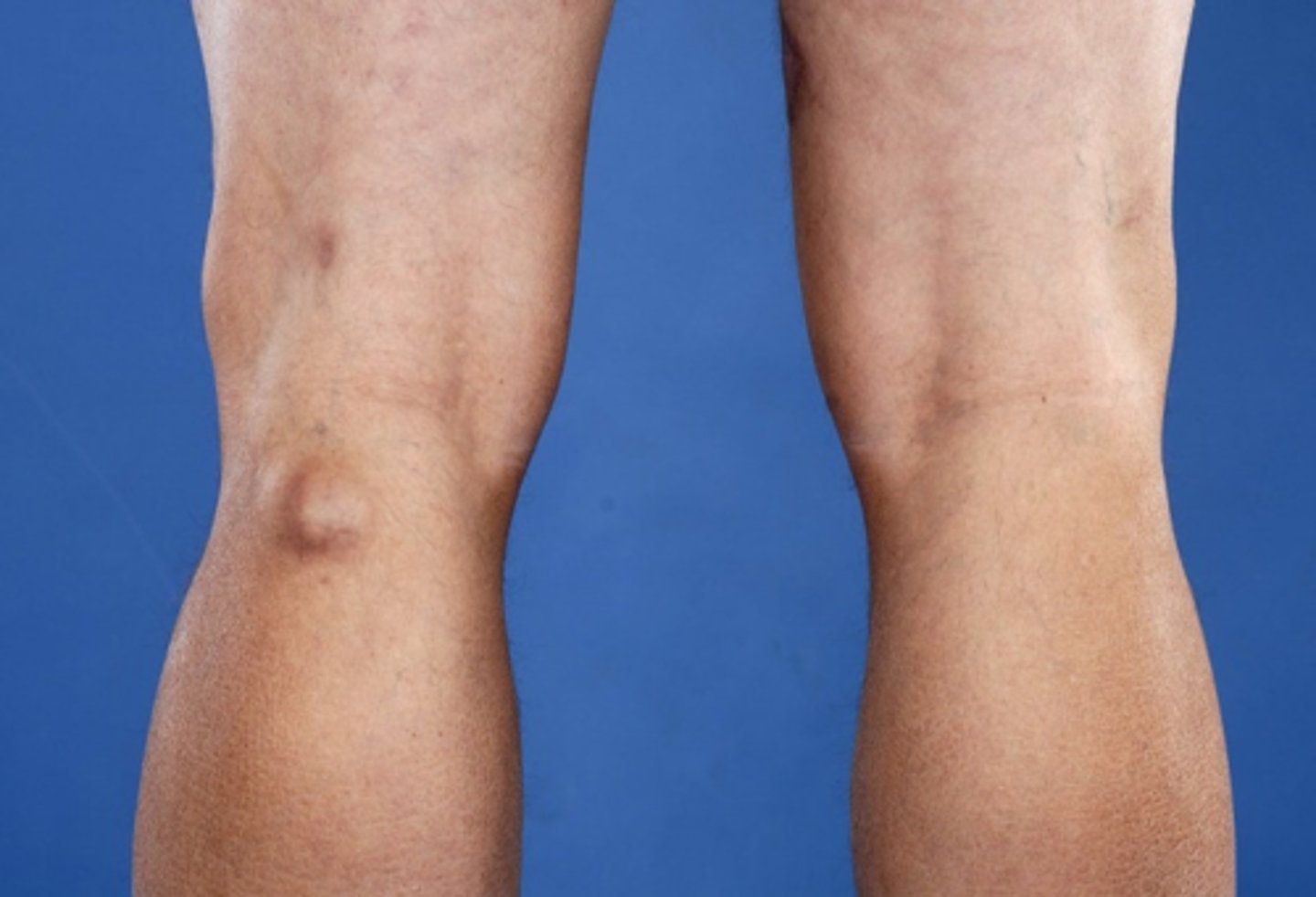 <p>- a fluid swelling in the popliteal fossa (behind the knee)</p><p>- caused from excess synovial fluid from the knee joint</p><p>- can present with tightness, swelling, or discomfort when extending the knee</p>