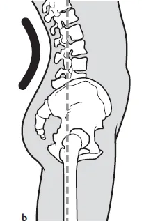 exaggerated anterior lumbar curvature (swayback)
