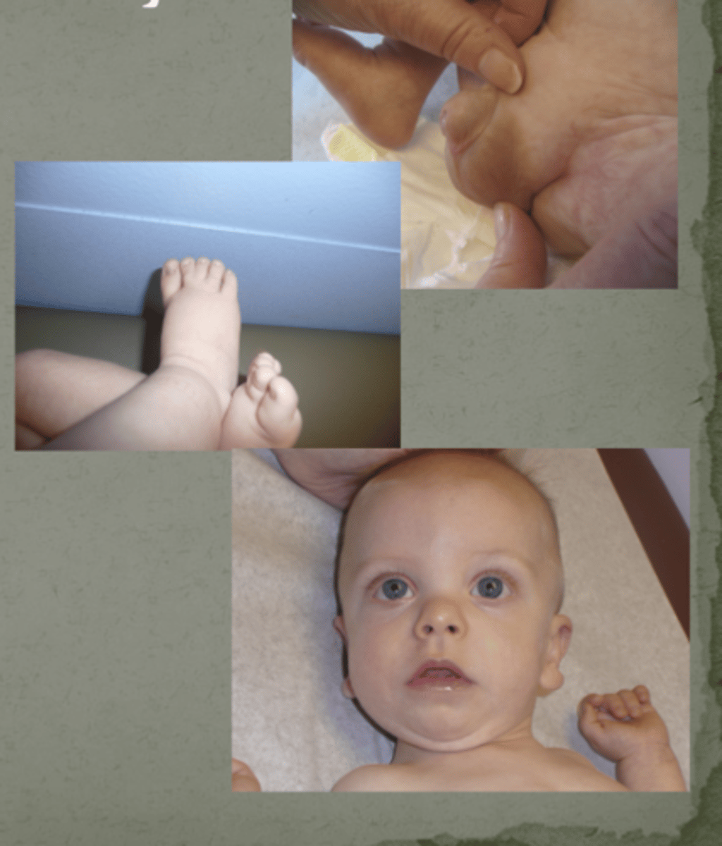 <p>Smith-Lemli-Opitz Syndrome</p>