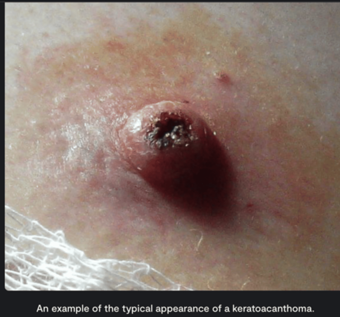 <p>- similar to an SCC</p><p>- but it is benign</p>