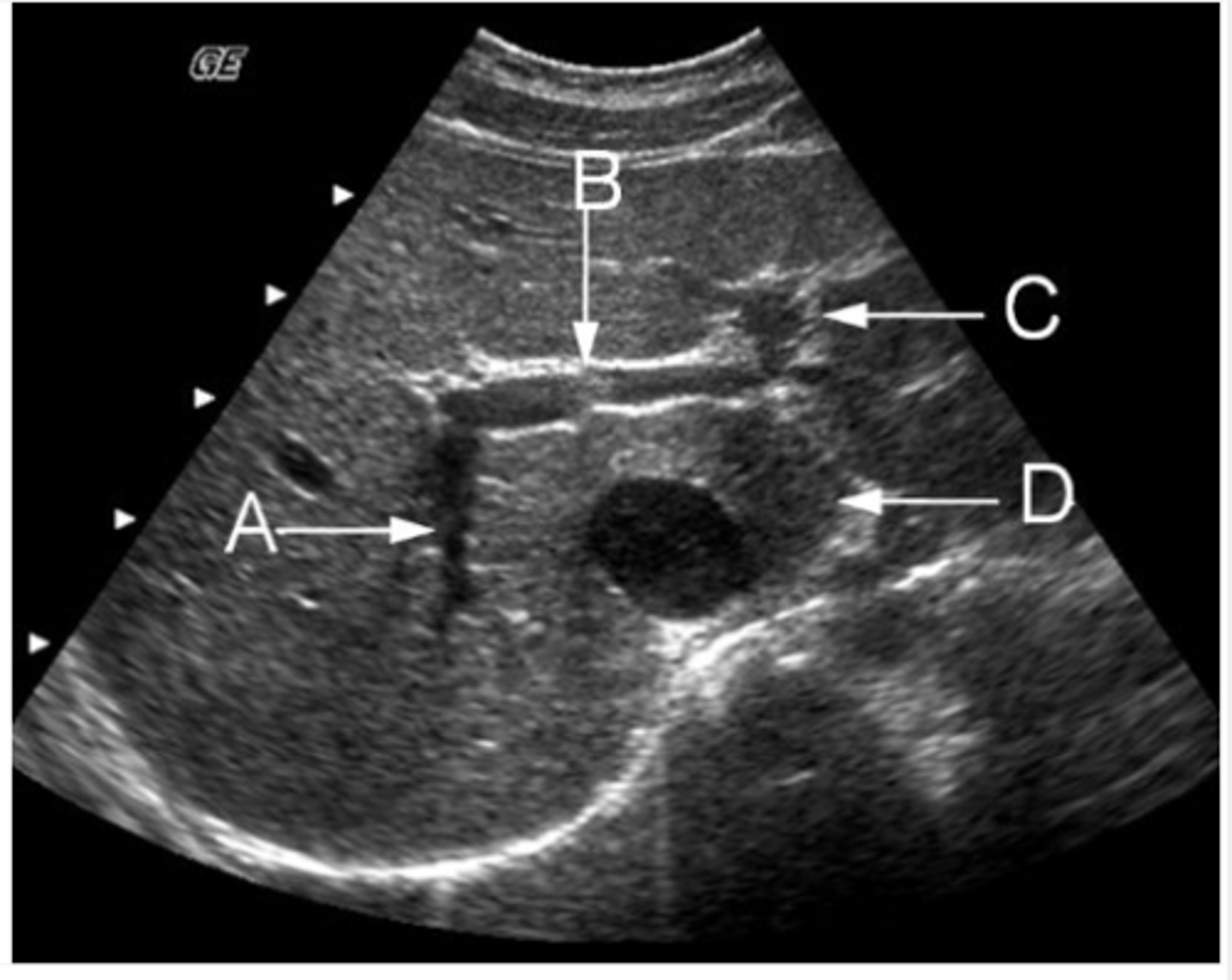 <p>The arrow labeled D is pointing to what lobe of the liver?</p><p>a. medial segment of left lobe</p><p>b. lateral segment left lobe</p><p>c. posterior segment right lobe</p><p>d. anterior segment right lobe</p><p>e. caudate lobe</p>