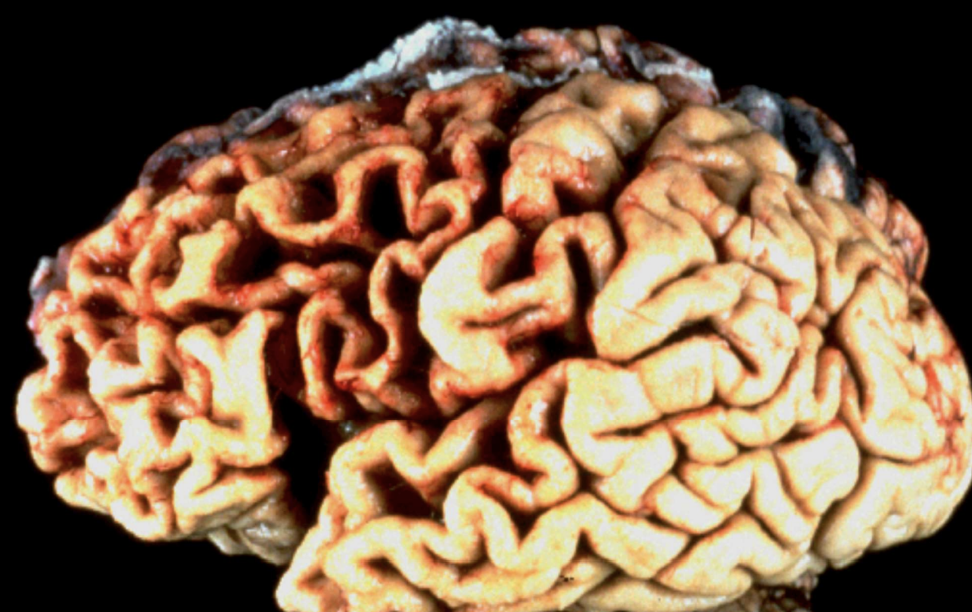 <p>Generalized Cerebral Atrophy</p>