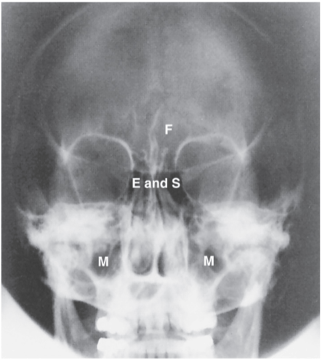 <p>What is the CR for PA axial (Caldwell Method)?</p>