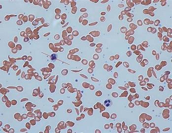 <p>Cause: inherited disorder mutated B hemoglobin chain</p><p>clumping NOT clotting of abnormally shaped RBCs from mutated hemoglobin chains</p><p>-damaged membranes increase <strong><u>hemolysis</u></strong></p><p>-blood vessel blockage, ischemia, chronic </p><p>-sickle shape</p>