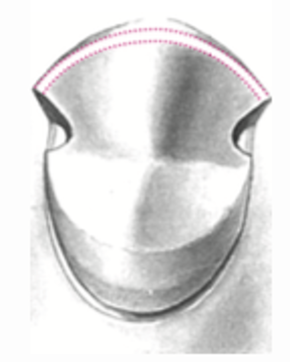 <p>What type of cast partial coverage restoration?</p>