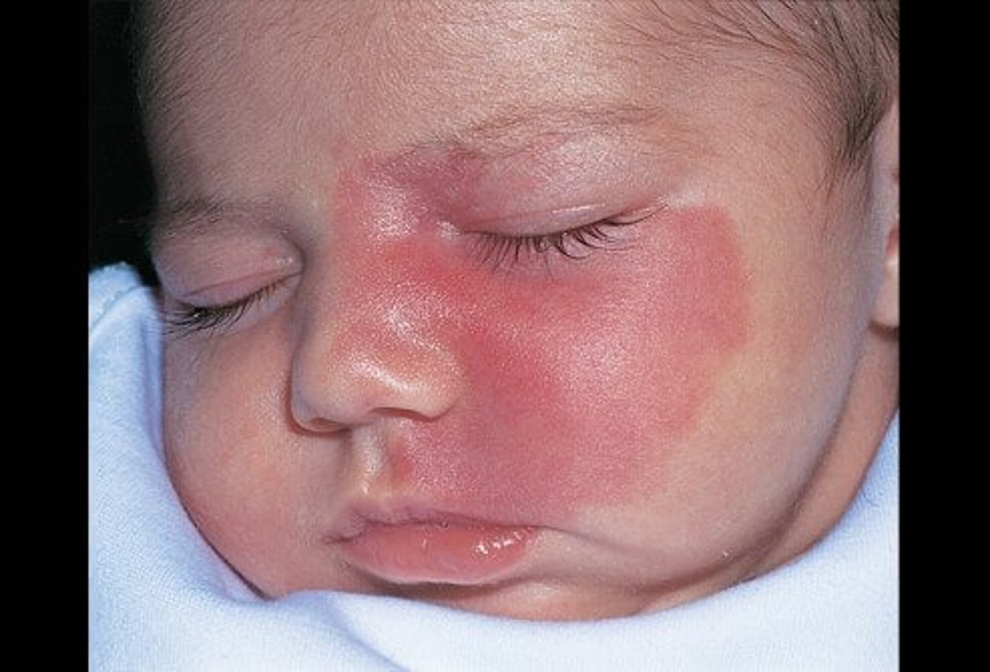 <p>Newly formed capillaries in the papillary layer of corium</p>