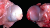 <p>Pathogenesis of avascular necrosis of the femoral head and its gross and histo features.</p>