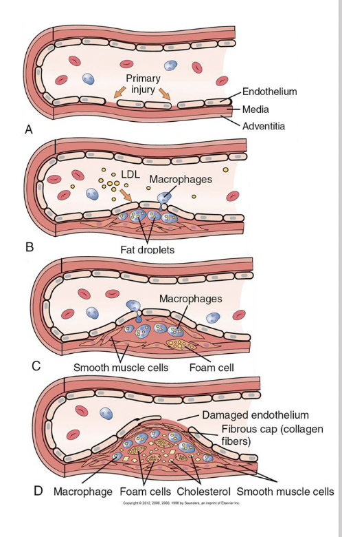<ul><li><p><strong>endothelial cell injury</strong> (metabolic derangements, physical force is accompanied by the deposition of blood platelets and serum lipoproteins)</p></li><li><p><strong>growth factors</strong> released from platelets stimulate the <strong>proliferation of smooth muscle cells</strong> in wall of the artery</p></li><li><p><strong>internal metabolism (cholesterol and other lipids in their cytoplasm)</strong></p></li><li><p><strong>smooth muscle cells transform into foam cells</strong></p></li><li><p><strong>attract macrophages (take up cell remnants) (foam cells) (secrete cytokines TNF, TGF-B—&gt;MORE DAMAGE)</strong></p></li><li><p><strong>collagen deposition with atheromas leads to hardening of the arteries (sclerosis)</strong></p></li></ul><p></p>
