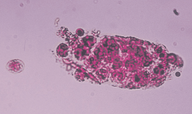 <ul><li><p>mostly PMN inside cast</p></li><li><p>granular</p></li><li><p>easy to confuse with WBC clumps</p></li><li><p>accompanied by free floating WBC</p></li></ul><p></p>