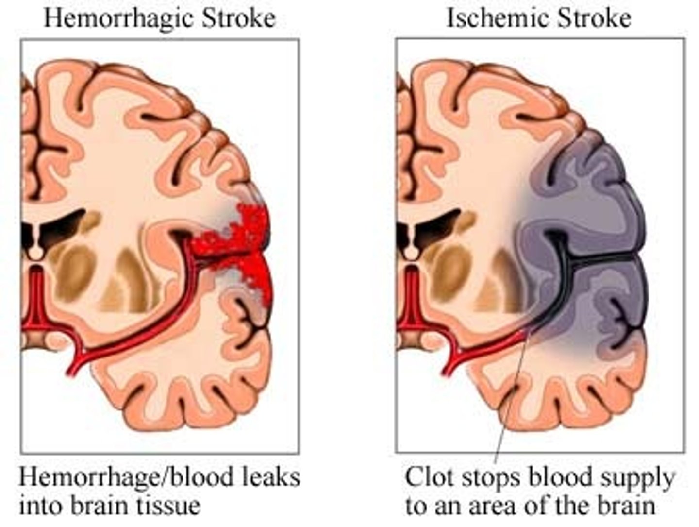 <p>Cerebral Vascular Accident (CVA) - caused by interruption in blood flow to the brain due to a blockage or bleeding in a cerebral artery usually near the LEFT temporal lobe</p>