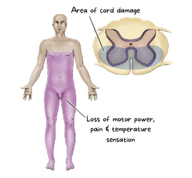 <p><strong><u>Cause</u></strong>:</p><ul><li><p>Acute disc herniation or hyper-flexion injuries r/t fractures/dislocation of vertebra</p></li><li><p>Result of injury to anterior spinal artery (supplies 2/3 of the spinal cord)</p></li></ul><p><strong><u>Characteristics</u></strong>:</p><ul><li><p>Loss of pain, temperature, motor function below level of lesion.</p></li><li><p>Light touch, position, and vibration sensation = intact</p></li></ul><p>*rare; complete motor paralysis but come intact sensory function; lower extremities more affected</p>