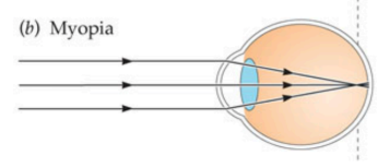 <ul><li><p>nearsightedness → close objects are clear, far objects are blurry</p></li><li><p>light focuses in front of retina</p></li></ul><p></p>