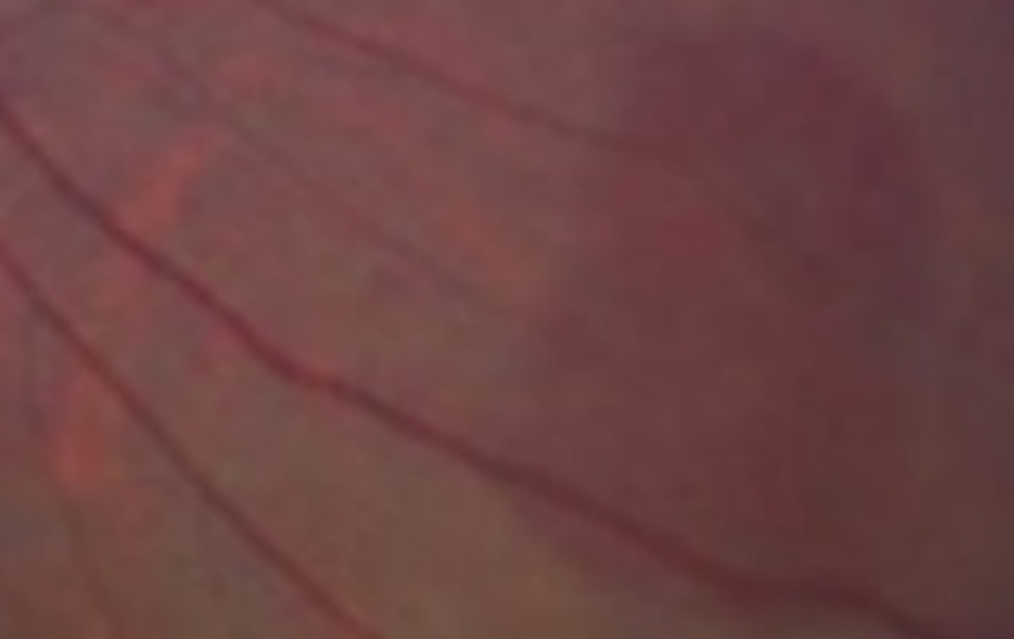 <p>patches of darkened retina associated with changes in the outer retina. Occurs in the central to mid peripheral zone. Generally benign and can be transient, but may have an association with sickle cell disease</p>