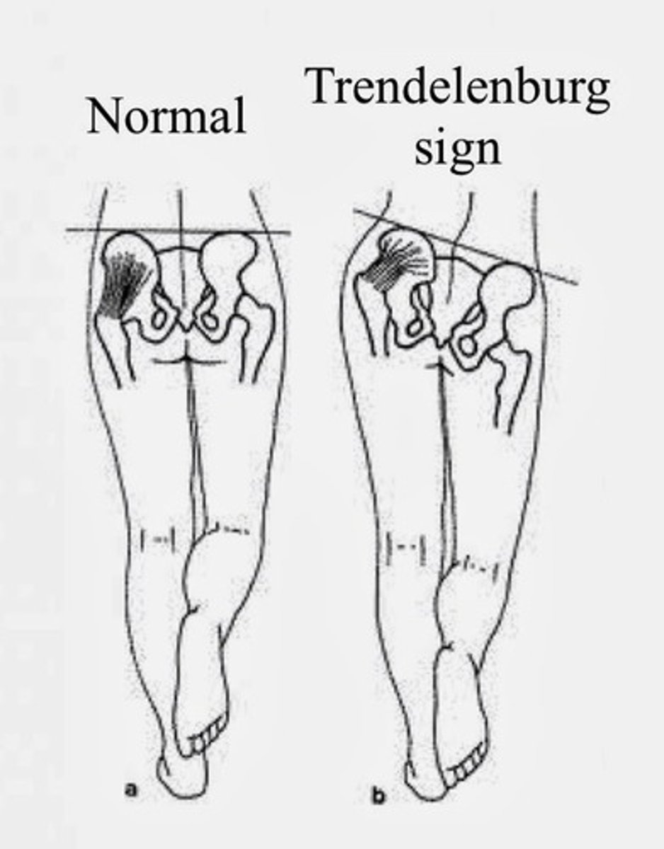 <p>pelvis drops on the side opposite to the leg that is bearing weight, resulting in a waddling or lurching motion</p>